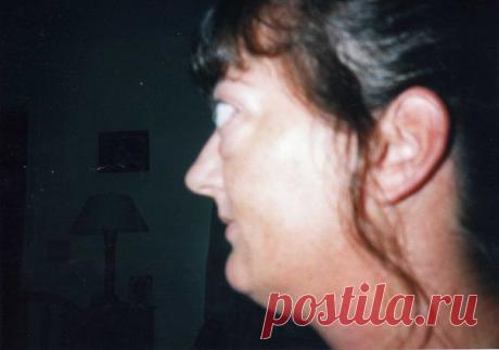 Офтальмопатия после RAI (фото).
Одна фотография может сказать больше, чем я напишу о проблемах, вызываемых радиоактивным йодом. Удивительная женщина Лайза Смит, живущая в городе Вирджиния-Бич (США), щедро поделилась своей историей с другими. Спасибо ей за это.

Посмотрите фотографии Лайзы до и после того как у нее развилась офтальмопатия после RAI, используемого для лечения болезни Грейвса /ДТЗ /Базедовой болезни. Она разрешила общий доступ к своим фотографиям, чтобы люди смогли  увидеть, нас