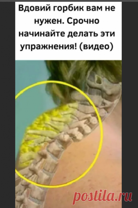 Особенности и лечение нароста «вдовий горб».

Делать его достаточно просто – необходимо в течение нескольких минут разминать место уплотнения и шею.