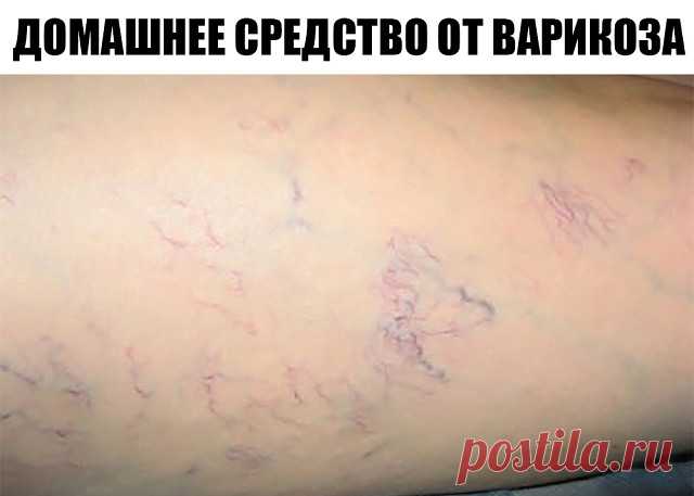 У всех дома есть это средство от варикоза, но никто о нем не знает

Почти каждый из нас знает, что такое варикоз. Эти «паучьи» сетки появляются на ногах, на руках, а иногда и там, где им быть вообще не следовало. Однако победное средство над варикозом есть дома у каждого. Просто не все знают, как его использовать.
Способ 1

Возьми зеленые помидоры и разрежь их попалам. Разрезом приложи к месту варикоза и оставь на 2-3 минуты. Очень важно, чтобы томаты были именно зелеными,...