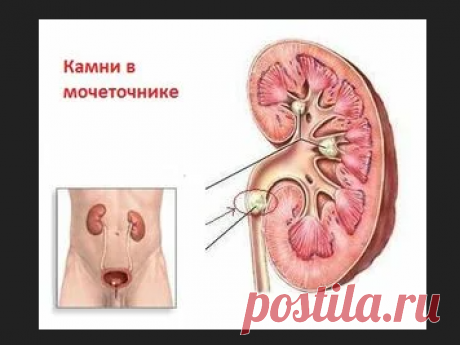 «Камни или песок в почках признаки, Советы доктора. Существует большое количество разных патологий органов мочевыведения, но даже если тщательно просмотреть последний выпуск Международного реестра болезней И главное правило – питьевой режим: объем выпитой воды за сутки должен составлять не более двух литров. Можно, но результат таких действий легко предсказать – формирование камней, развитие почечной колики и наруш...