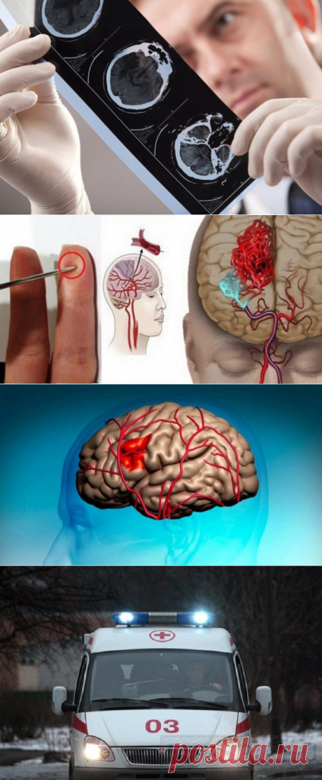 Как простая игла может спасти вам жизнь в случае инсульта? / Будьте здоровы
