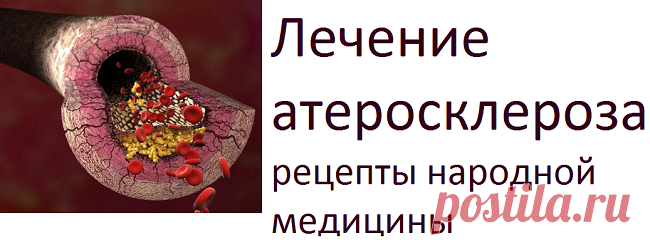 Лечение атеросклероза. Рецепты народной медицины | Советы целительницы