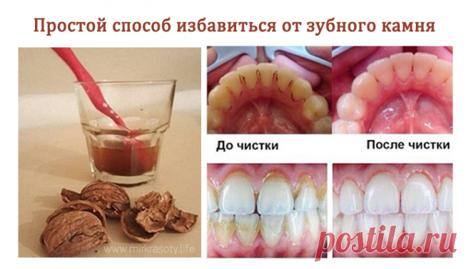 Как избавиться от зубного камня без посещения стоматолога?