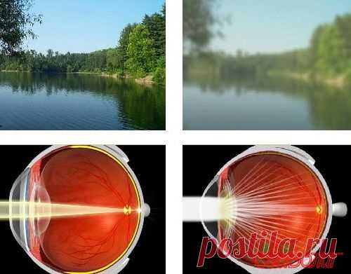 Народные средства лечения катаракты