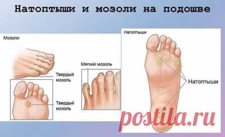 Как избавиться от натоптышей. 
Требуется: 
Мыльно-содовая ванночка для ног: 
1. сода, 
2. хозяйственное мыло, 
3. вода 
Маска от натоптышей: 
1. аспирин, 
2. лимонный сок, 
3. вода, 
4. полиэтилен 
Избавляемся от натоптышей на ногах 
Делаем ванночку. 
Для этого возьмем 3 чайные ложки соды и 1 столовую ложку наструганного хозяйственного мыла. Все это растворим в 1 литре горячей воды (Если у вас емкость для ножных ванночек большая, то увеличьте пропорционально все компоненты). Опустим