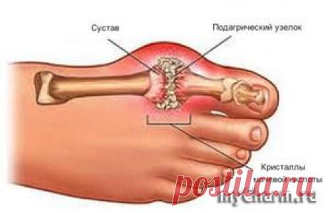Подагра: симптомы и лечение: Группа Женское здоровье