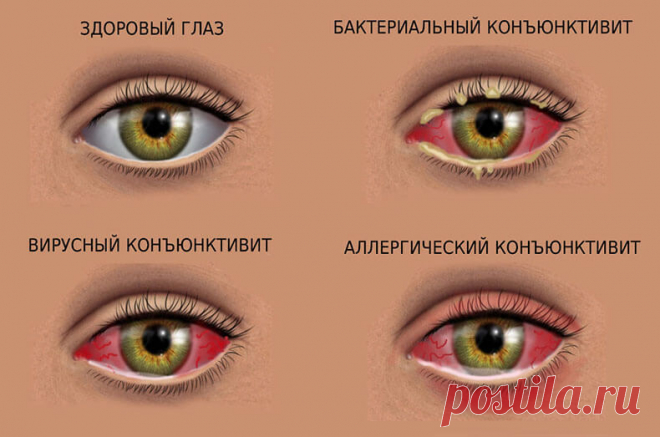 Коньюктивит: эффективное лечение натуральными средствами