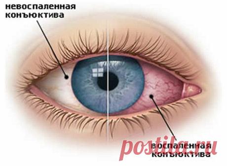 Как лечить коньюктивит в домашних условиях. | Народная медицина