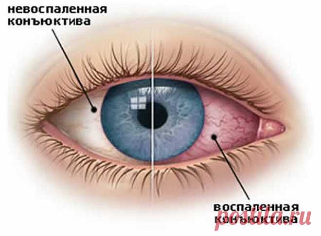 Как лечить коньюктивит в домашних условиях. | Народная медицина