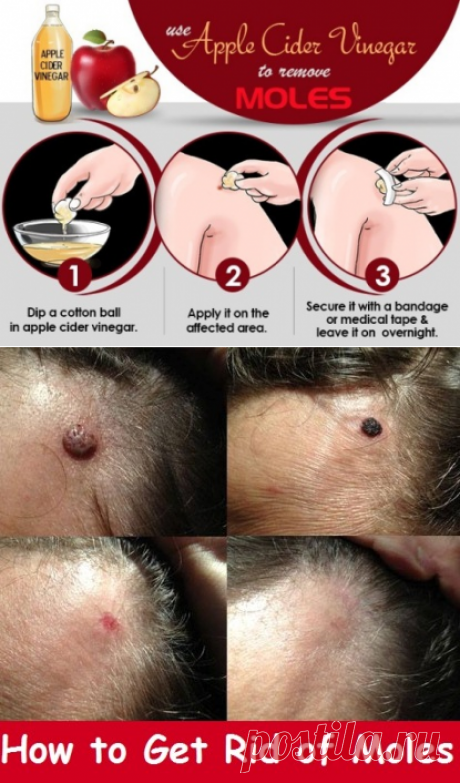 How to Get Rid of Moles | Virtual Clinic