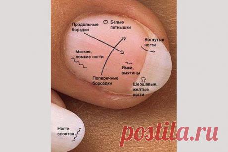 Перемены в облике, форме или цвете ногтей могут указывать на болезни и расстройства организма задолго до появления других симптомов.


* Белый цвет ногтей говорит об анемии или о проблемах с почками.

* Вмятины и коричневые пятна или трещины на ногтях указывают на псориаз. 

* Различие в длине ногтей или другие аномалии в их развитии свидетельствуют о неполноценном питании или о расстройстве пищеварения.

* Белые поперечные линии указывают на болезни печени. 

* Наполовину белый