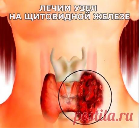 ЛЕЧИМ УЗЕЛ НА ЩИТОВИДНОЙ ЖЕЛЕЗЕ

Смешайте по одному стакану молотой гречневой крупы, пропущенных через мясорубку грецких орехов и меда в эмалированной (абсолютно чистой) посуде и переложите в стеклянную банку. 
Один раз в неделю за целый день съешьте этот состав, не принимая больше никакой пищи, кроме воды. 
Сделайте так шесть раз, т. е. шесть недель. 
Затем через месяц повторите лечение. 
Уже после первого курса зоб уменьшится, а после второго болезнь оставит вас. Проверь...