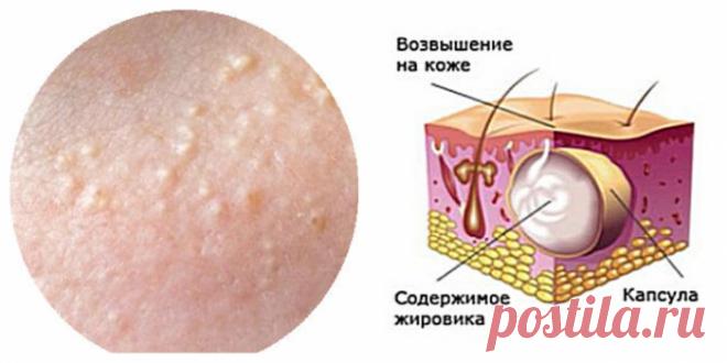 Домашние средства лечения жировиков на лице — можно ли, и как удалить жировики в домашних условиях.
