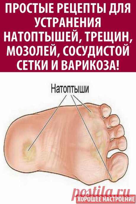 Простые рецепты для устранения натоптышей, трещин, мозолей, сосудистой сетки и варикоза!
