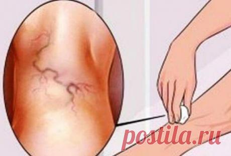 Избавиться от варикозного расширения вен и сосудистых звёздочек поможет оливковое масло » Кулинарный сайт