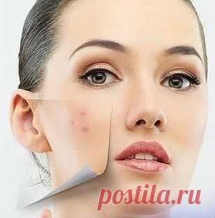 4 ЭФФЕКТИВНЫХ СПОСОБА УБРАТЬ ШРАМЫ ОТ ПРЫЩЕЙ