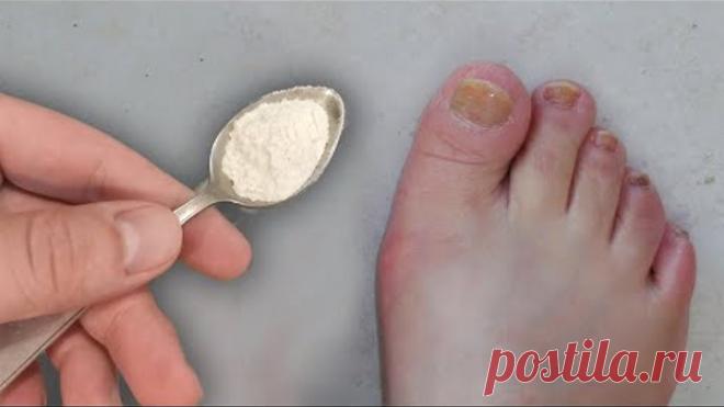 1 ложка этого и грибок ногтей исчезнет за 10 минут