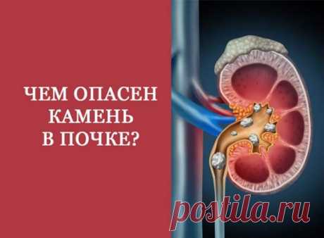 Чем опасны камни в почках - Народная медицина - медиаплатформа МирТесен идронефроз — это заболевание почки, характеризующееся расширением ее чашечек и лоханки, прогрессирующим истончением почечной ткани, сопровождающееся нарушением всех основных функций почки. Гидронефроз может быть врождённым или приобретённым вседствие других заболеваний. Гидронефроз (от греческого
