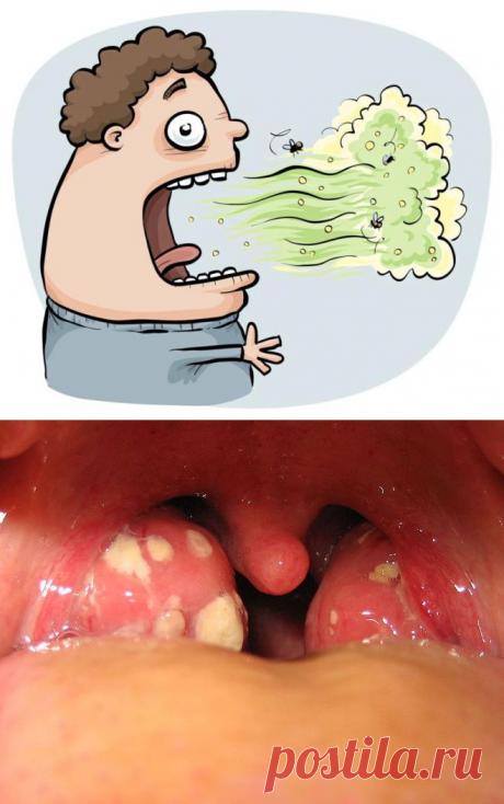 Комочки с ужасным запахом, которые появляются во рту