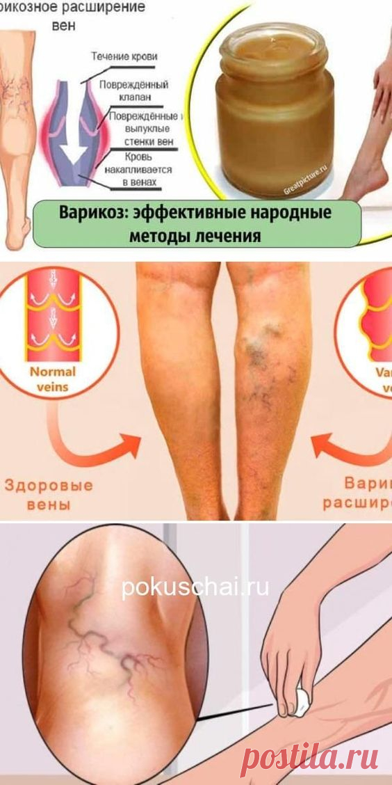 Чего боится варикоз: эффективные народные методы лечения