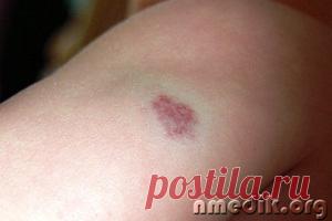 Рак кожи - лечение народными средствами Рак кожи – злокачественная опухоль из клеток эпителия кожи. В раковые опухоли могут превращаться родинки и бородавки. Рак кожи обычно встречается у пожилых людей, чаще на коже лица.