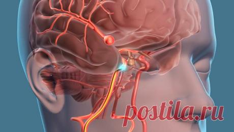 Аневризма сосудов мозга: ранние признаки
Аневризмой сосудов мозга называют такое состояние стенки сосудов, при котором она слабеет и выпячивается. Подобное состояние для человека смертельно опасно — в 40% всех случаев разрыва такой аневризмы с кровоизлиянием в мозг, дело оканчивается летальным исходом. Правда, слабые сосуды в большинстве своем не рвутся, но, если это случается, важно действовать быстро. Чем оперативнее больному будет […]
Читай пост далее на сайте. Жми ⏫ссылку выше