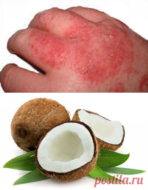 Psoriāzes mājas līdzeklis