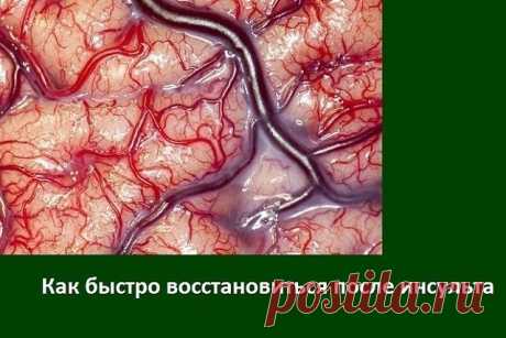 Значит так…Как мы восстановливались после инсульта мозга.

1. Во-первых — аспирин. Кроверазжижающее. Каждый день. По 1 таблетке, размолотый в порошок. Смешать с сахаром и принимать.
И статины. Но…только, если печень здоровая. Абсолютно здоровая. Очень плохие побочные эффекты…У нас — Симвастатин.

2. С утра натощак — если очень высокое давление — 2 СТОЛОВЫХ ложки кунжутного масла смешать с 1 ст.ложкой меда. съесть. Прилечь минут на 20. Сбивает давление сильно, но мягко. Я д...