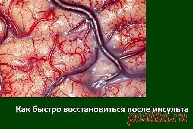 Значит так…Как мы восстановливались после инсульта мозга.

1. Во-первых — аспирин. Кроверазжижающее. Каждый день. По 1 таблетке, размолотый в порошок. Смешать с сахаром и принимать.
И статины. Но…только, если печень здоровая. Абсолютно здоровая. Очень плохие побочные эффекты…У нас — Симвастатин.

2. С утра натощак — если очень высокое давление — 2 СТОЛОВЫХ ложки кунжутного масла смешать с 1 ст.ложкой меда. съесть. Прилечь минут на 20. Сбивает давление сильно, но мягко. Я д...