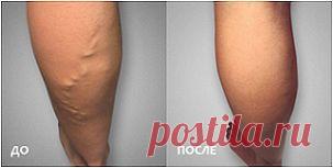 Уксусное обертывание для похудения: как делать? Уксусное обертывание: отзывы | LS