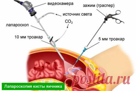 Лапароскопия кисты яичника: преимущества, реабилитация