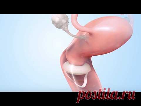 Vaginal Sponge