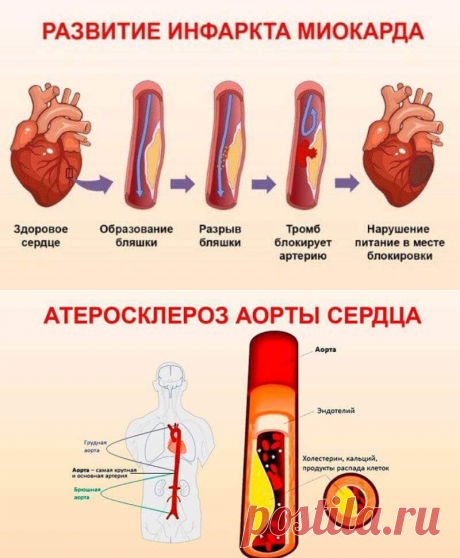 Почему чистка сосудов в зрелом возрасте – средство выживания, а не роскошь?
Чем грозят холестериновые бляшки?
Накопление холестерина на стенках сосудов активно начинается после 40 лет, а после 50-ти принимает лавинообразную скорость. Возникающие «холестериновые» преграды ухудшают кровоток. Постепенно образовывается атеросклеротическая бляшка, а диаметр сосуда становится все меньше. Это многократно увеличивает риск закупорки сосуда тромбом| новогодние украшения для окон | начинки для тарталеток