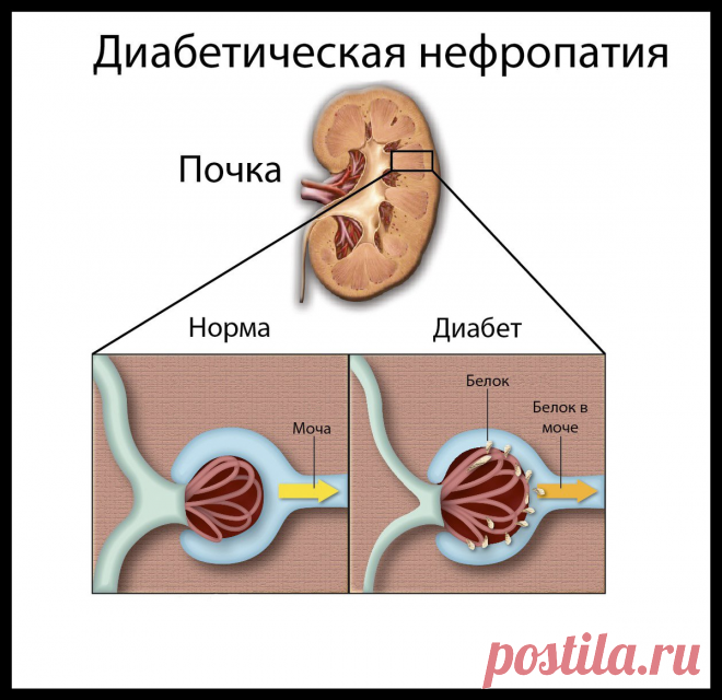7 правил защиты почек при диабете. Остановите повреждение почек и не допустите развитие терминальной почечной недостаточности! | Врач-эндокринолог Тимченко Юлия Владимировна | Дзен