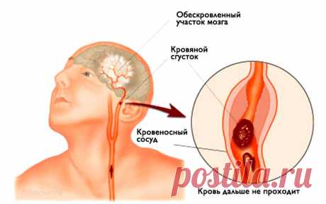 Инсульт: запомните всего 3 первых шага, чтобы спасти себе и близким жизнь!