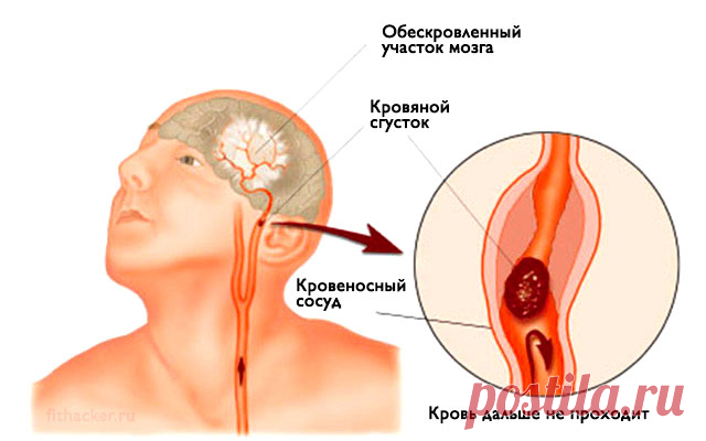 Инсульт: запомните всего 3 первых шага, чтобы спасти себе и близким жизнь!