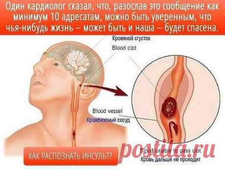 Как распознать инсульт