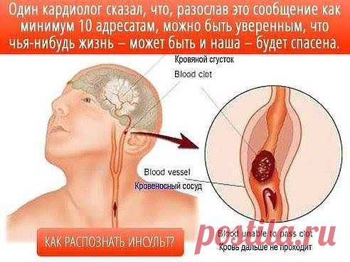 Как распознать инсульт