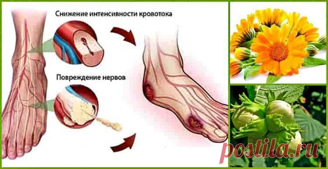 Что такое диабетическая нейропатия? Это заболевание связано с расстройством всех  нервов, относящихся к периферической нервной системе, отвечающих за чувствительность, вегетативные и двигательные функции.
