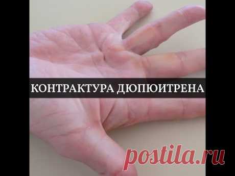 Контрактура Дюпюитрена