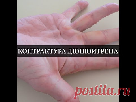 Контрактура Дюпюитрена