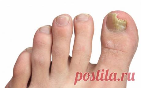 Лечение грибка ногтей народными средствами — самые эффективные методики Поражение ногтевой пластины и окружающей ее кожи может свидетельствовать о развитии микоза. Грибок распространяется с невероятной скоростью, поэтому лечение заболевания следует начать незамедлительно.