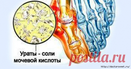8 лучших средств для устранения мочевой кислоты, боли в суставах и подагры