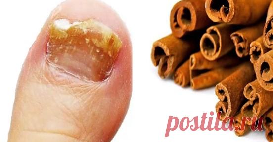 Ни один грибок не выжил в этом мощном гербициде с корицей. Здесь мы расскажем, как его подготовить
Грибок на ногтях — это инфекция, которая проникает через щели ваших ногтей на ногах или даже через раны на коже. Если ногти меняют форму или, возможно, отделены или сняты с кожи, они могут быть инфицированы, и если инфекция тяжелая, они обычно могут быть связаны с болью. Это может произойти в результате пота, влаги и тепла, […]
Читай пост далее на сайте. Жми ⏫ссылку выше