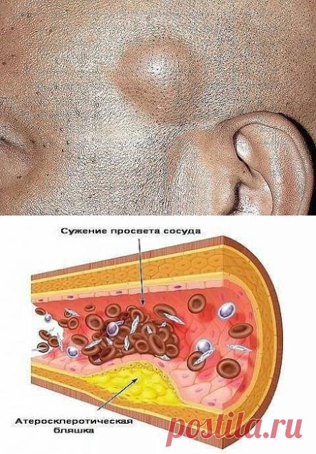 1. ЛЕЧИМ ЖИРОВИК
2. Лечение тромбоза сосудов народными средствами
3. Соль снимает головную боль!
4. Метод избавления от висячих родинок.