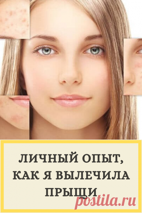 Личный опыт, как я вылечила прыщи