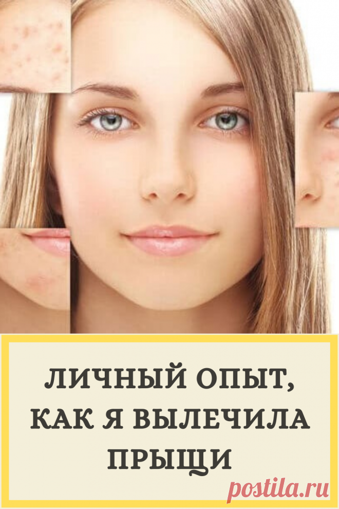 Личный опыт, как я вылечила прыщи