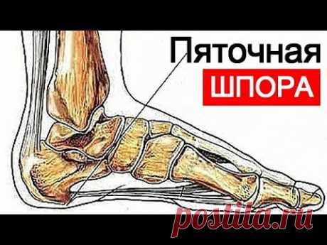ПЯТОЧНАЯ ШПОРА Выздоравливайте за 2 дня  Просто и легко