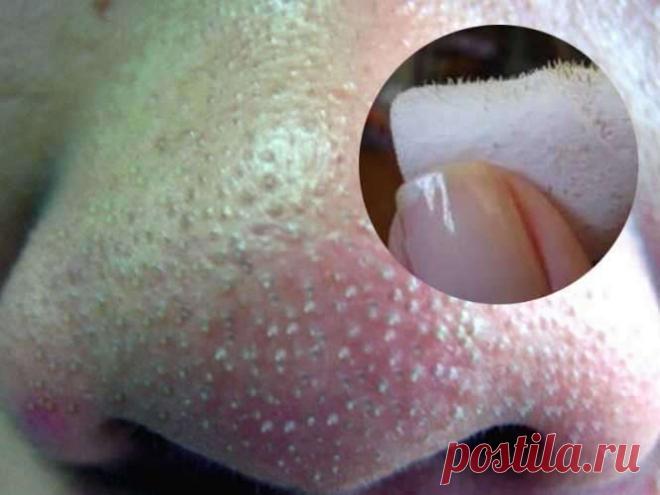 Один простой трюк, который поможет навсегда забыть о черных точках — ХОЗЯЮШКА24