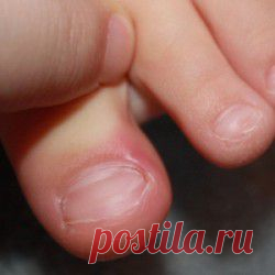 Вросший ноготь: лечение дома | Красота женщины